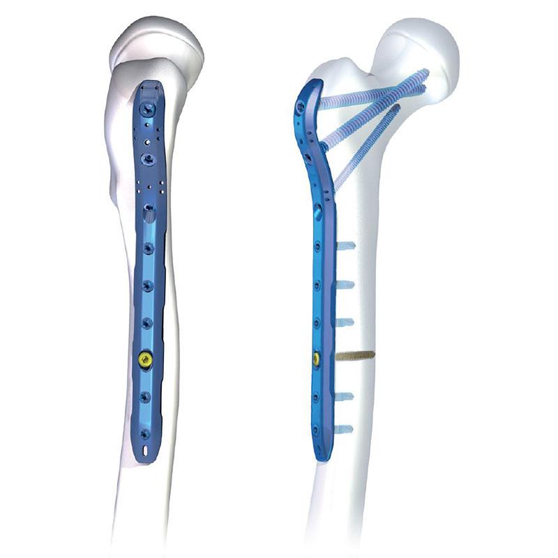 Пластина для проксимального відділу плечової кістки 7.0 ChLP